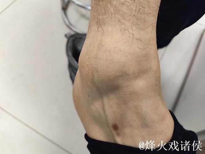 加福德:右脚踝感觉好多了,这是长时间以来感觉最好的一次 加福德:右脚踝感觉好多了,这是长时间以来感觉最好的一次